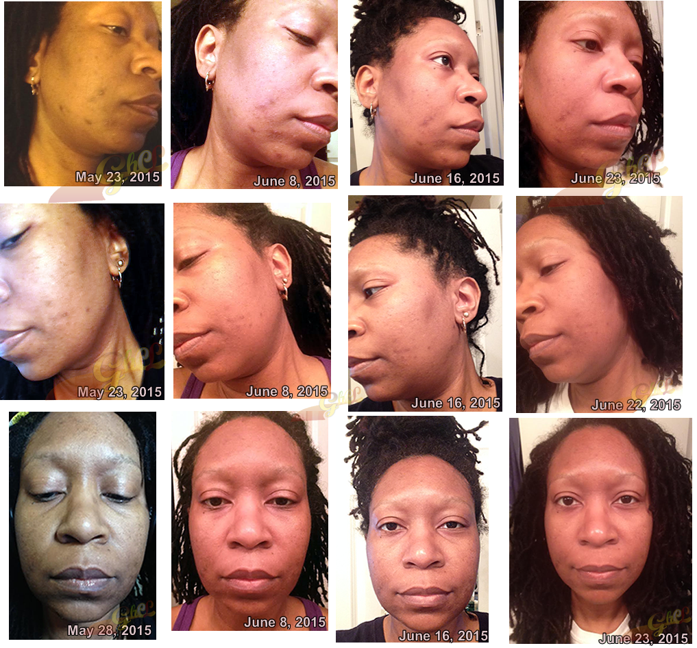 cherie iaso oil face pics may-june 2015